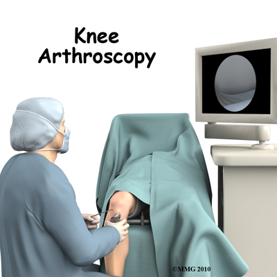 Knee Arthroscopy