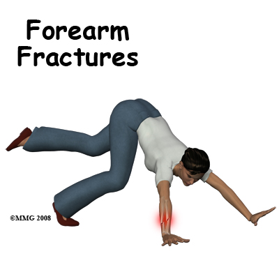 Adult Forearm Fractures