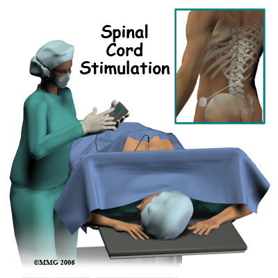 Spinal Cord Stimulators