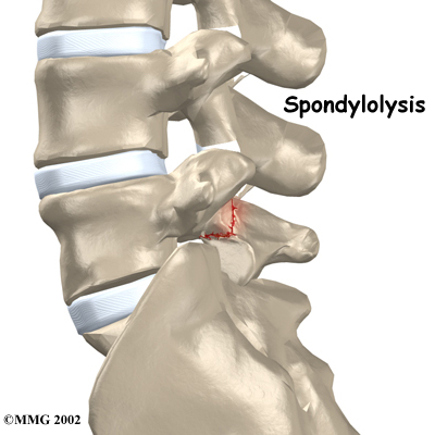 Lumbar Spondylolysis