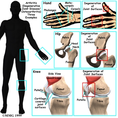 váll osteoarthritis