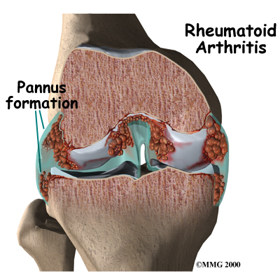 váll rheumatoid arthritis lábízületi fájdalom fekve