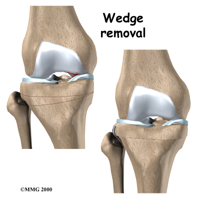 az ágyéki szakrális régió osteochondrosisának kezelése fájdalom a gerinc mindkét oldalán