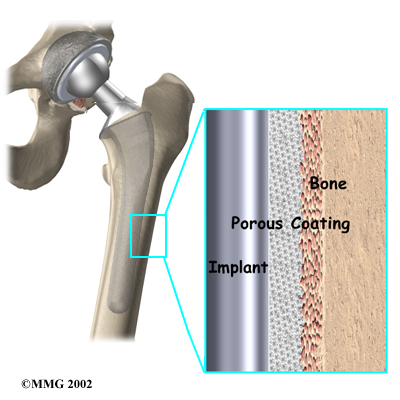 Uncemented Prostheses  . Uncemented Total Hip Arthroplasty 19.