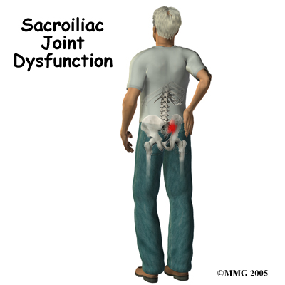 Sacroiliac Joint Dysfunction