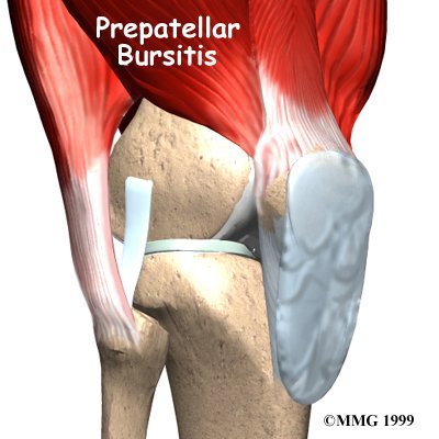 Prepatellar Bursitis