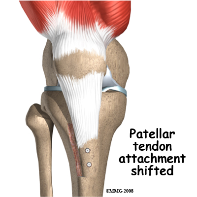 patella misaligned