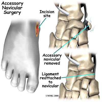Physical Therapy In Erie For Accessory Navicular Problems