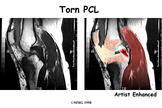 Physical Therapy In Erie For Posterior Cruciate Ligament Injury