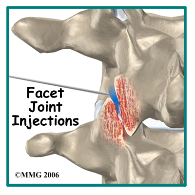 Facet Joint Injections