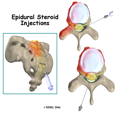 Epidural Steroid Injections