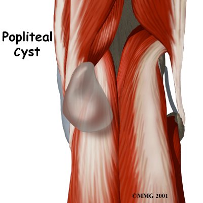 Popliteal Cysts