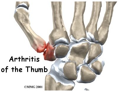 Arthritis of the Thumb