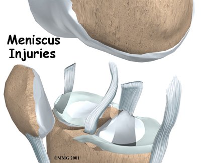 Meniscal Injuries