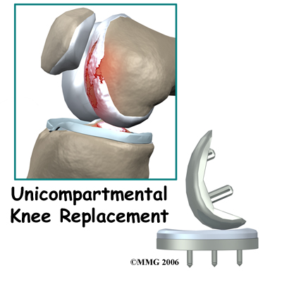 Unicompartmental Knee Replacement