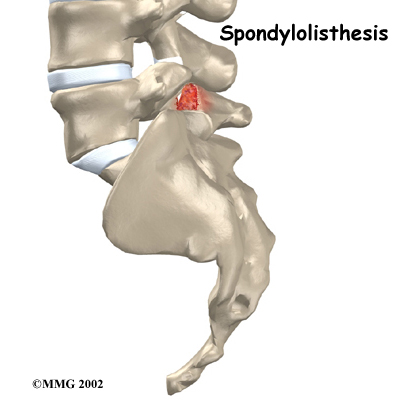 Lumbar Spondylolisthesis